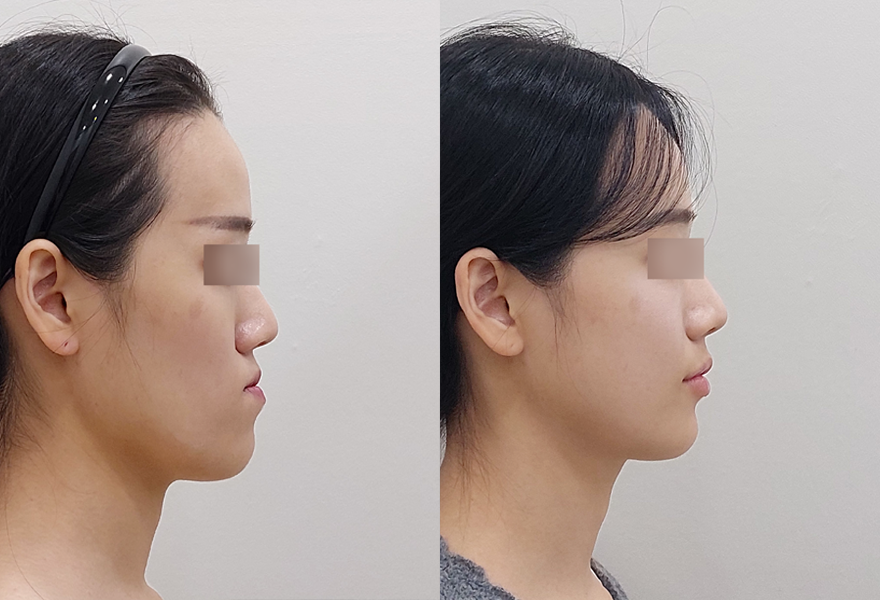Facial contour surgery before/after 1
