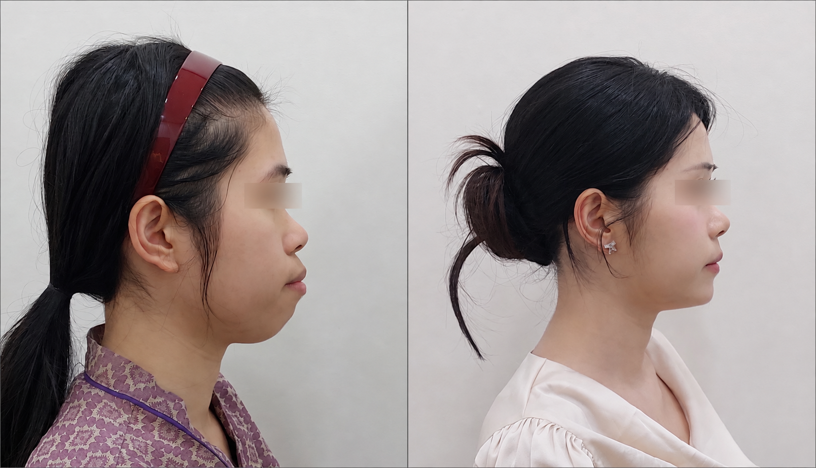 Facial contour surgery before/after 2