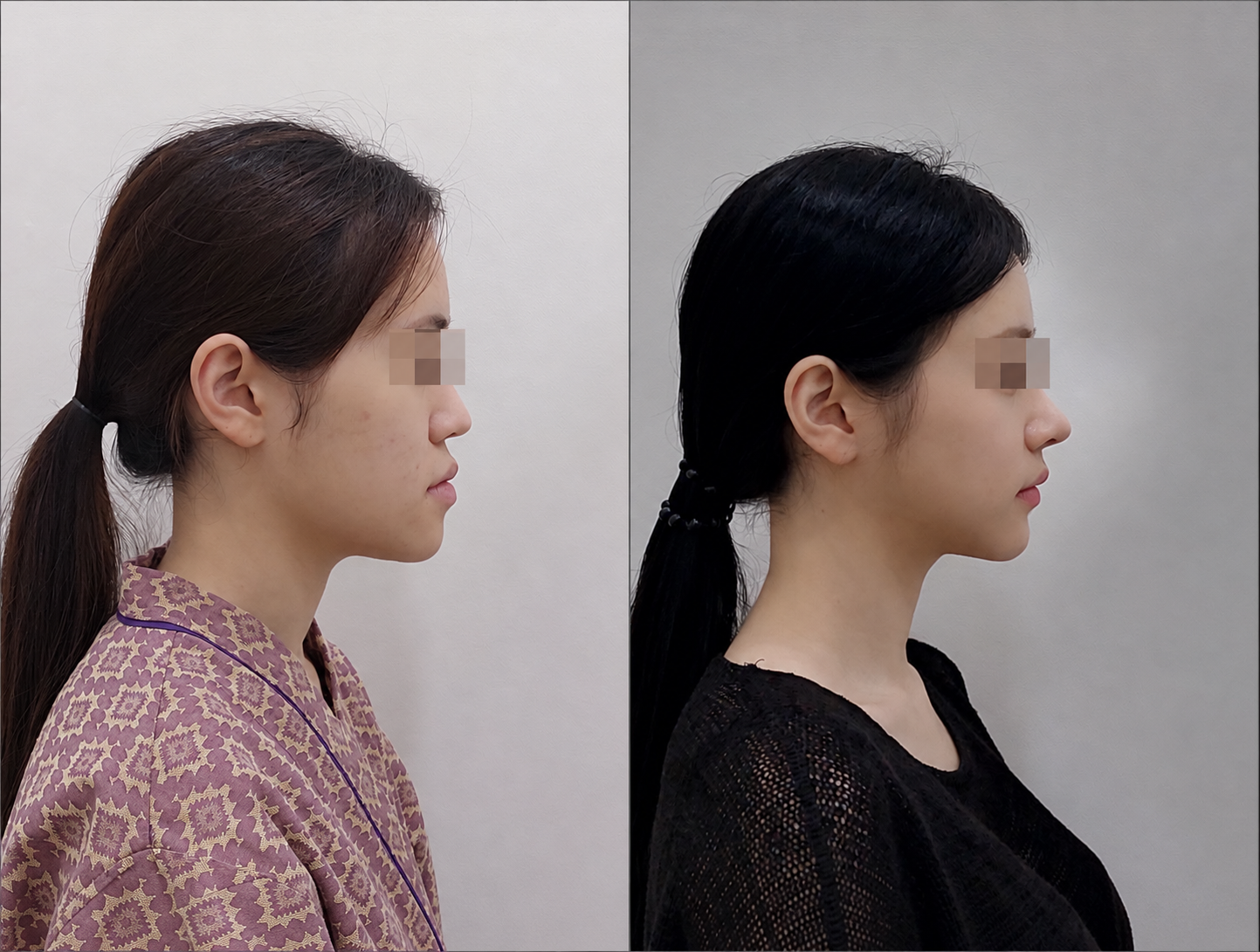 Facial contour surgery before/after 3