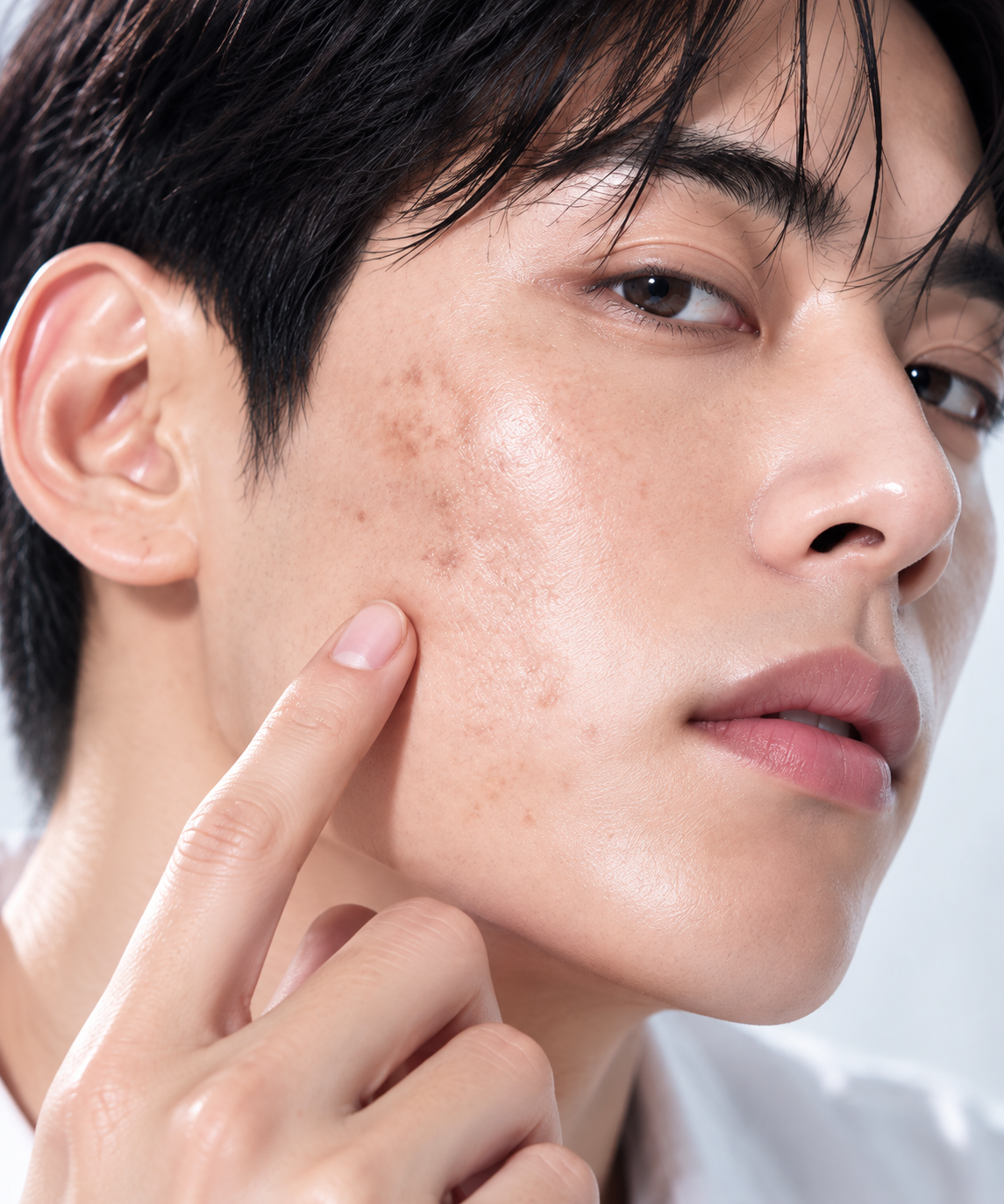 Dark Spots · Acne · Scars · Redness