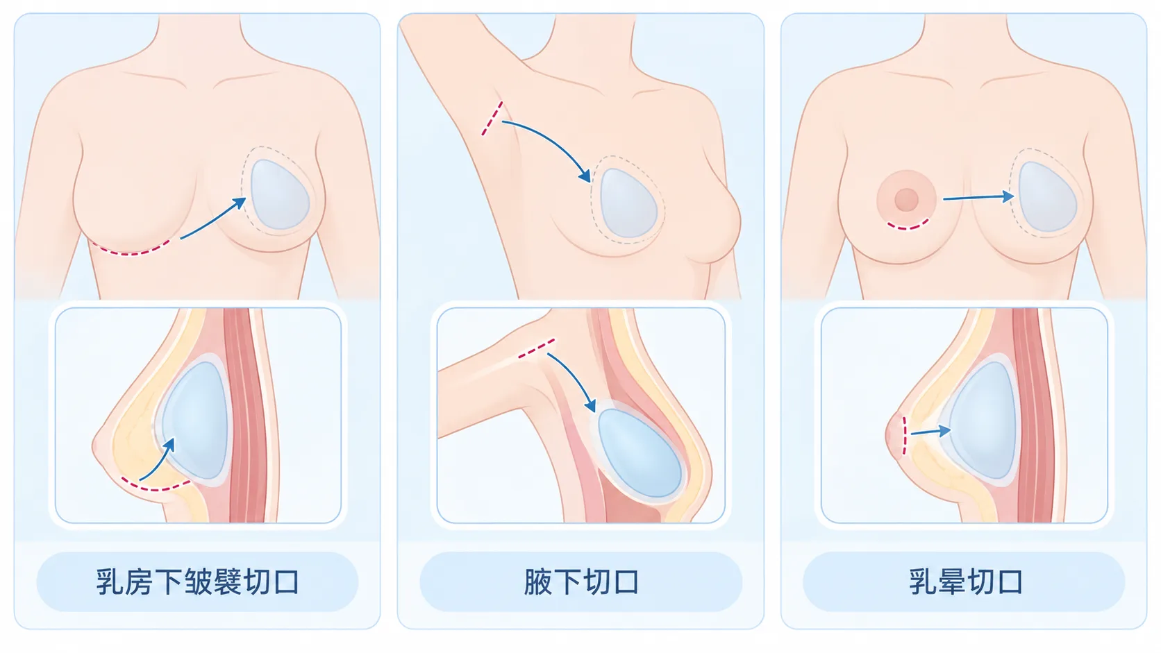 隆胸假体常见切口方式